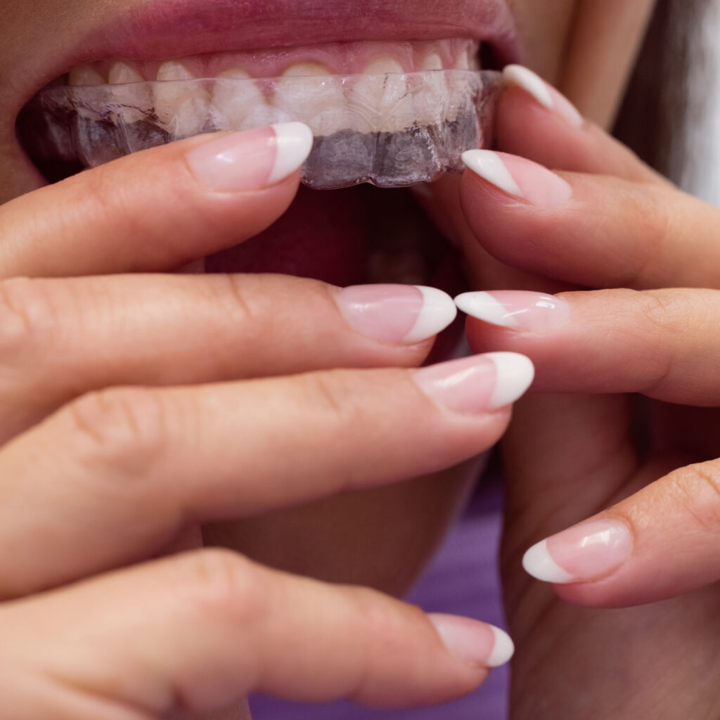 Close-up of female patient wearing braces in dental clinic