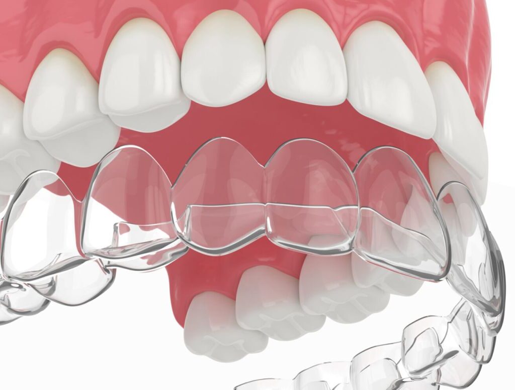 alinhadores invisíveis Invisalign